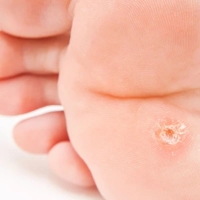 What is a callus? And how do you treat it? 