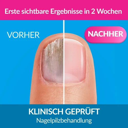  Lösung gegen Nagelpilz