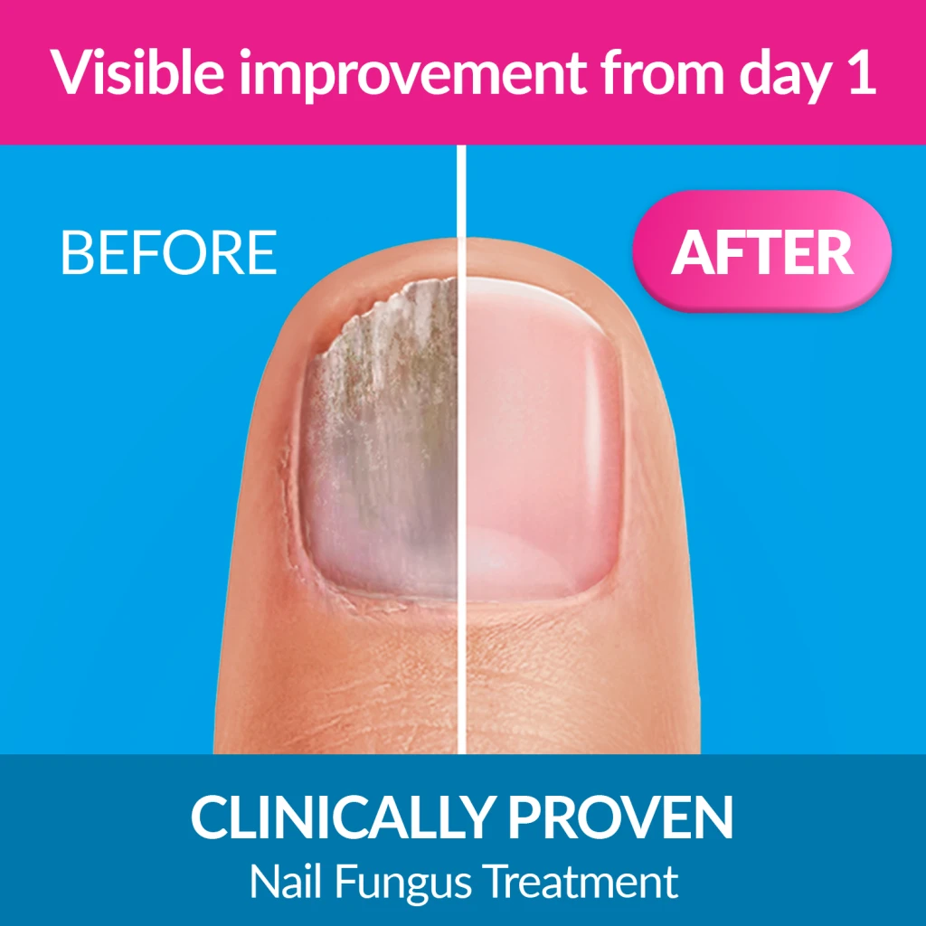 Excilor Nail Fungus Ultra for persistent nail fungus