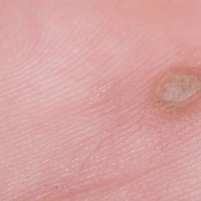 What are the different types of warts? 