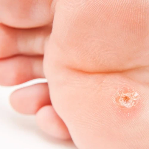 What is a callus? And how do you treat it? 
