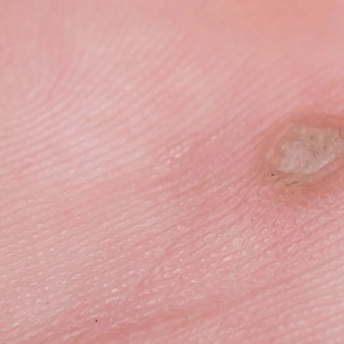 What are the different types of warts? 