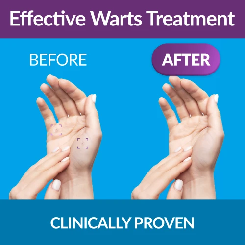  Warts Treatment