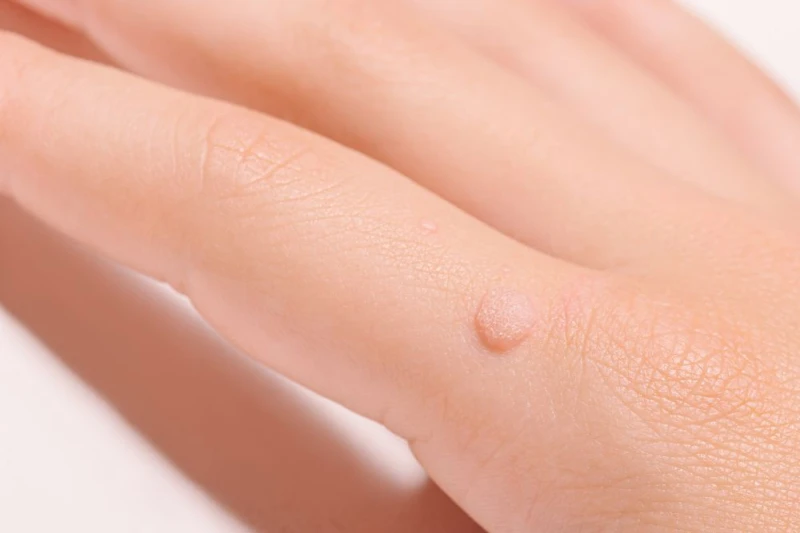 Demystifying Common Warts: Features, Contagion, Treatments