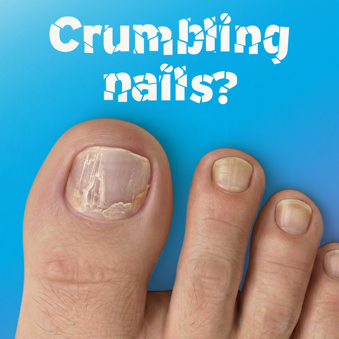 Nail condition 3