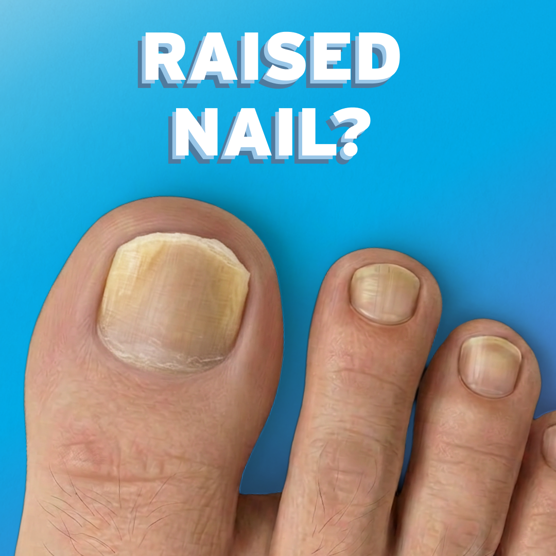 Nail condition 2