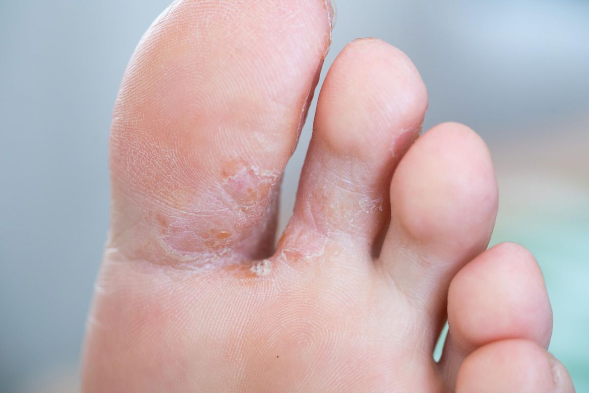 Mycose Entre Les Orteils Photos Mycose des pieds
