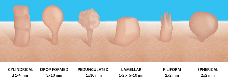 Skin tags